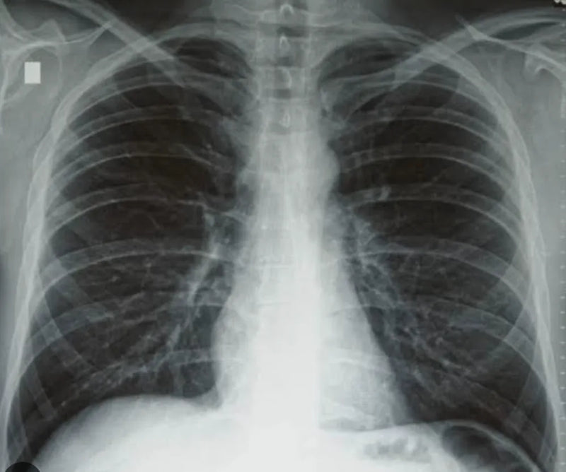 Radiografía de tórax con los pulmones y los bronquios
