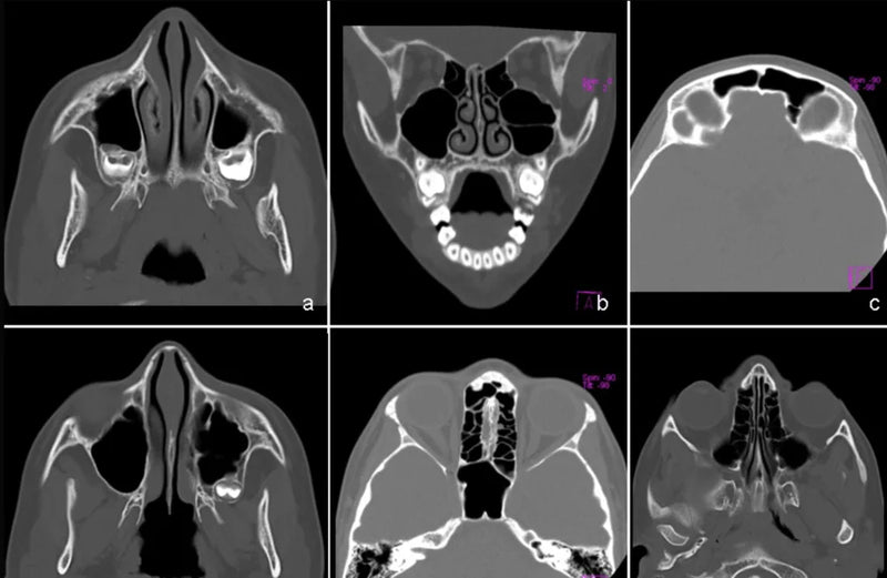 Tomografías de la cara con los senos paranasales