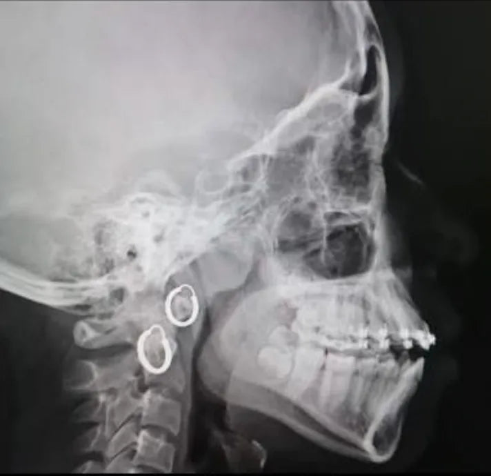 Radiografía lateral de cabeza y cuello con las vías aéreas respiratorias